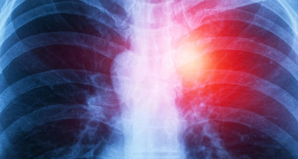x-ray of Mesothelioma in the chest